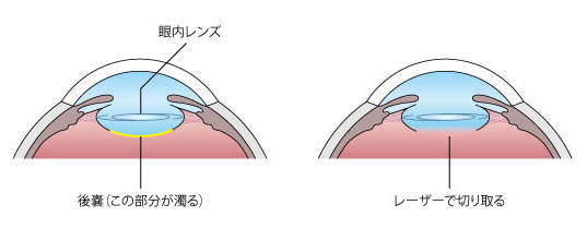 手術イメージ