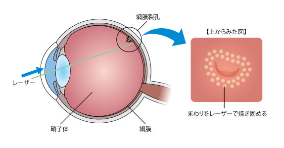 手術イメージ